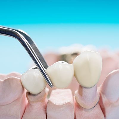 dental bridges thornton