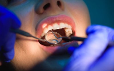 Temporary vs Permanent Dental Fillings