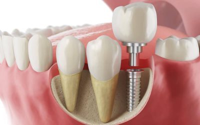 How Dental Implants Can Replace Missing Teeth Effectively