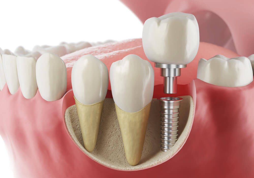 How Dental Implants Can Replace Missing Teeth Effectively