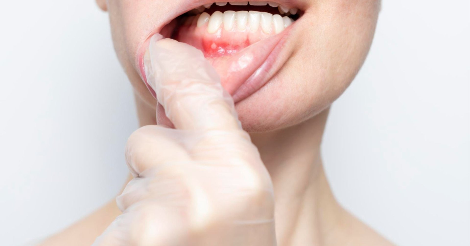 Dental assessment of a persistent mouth ulcer in Thornton