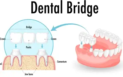 Dental Bridges: When They Are the Right Fix for a Missing Tooth