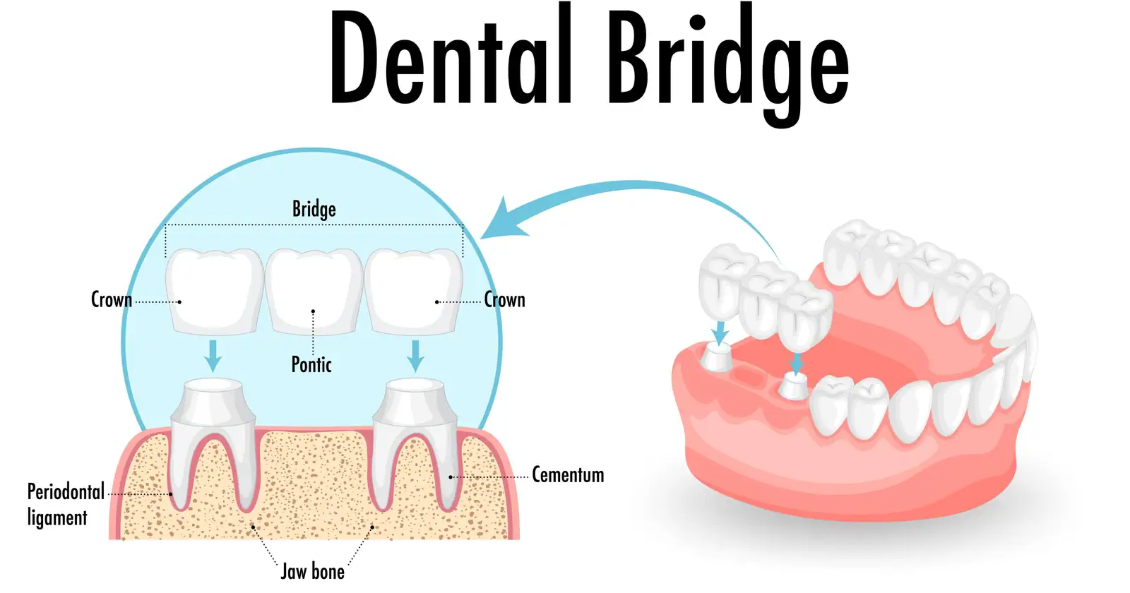 labelled diagram of a dental bridge showing the crown pontic and supporting structures in Thornton